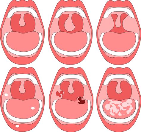 口穴|【口内炎】はなぜできる？原因や種類できてしまった。